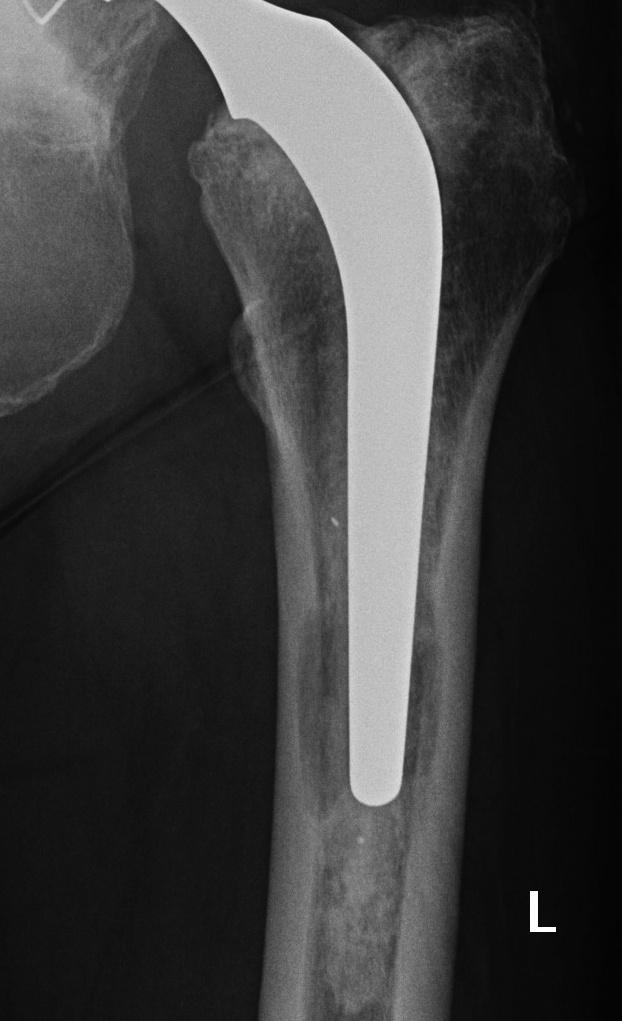 Revision THR Osteolysis